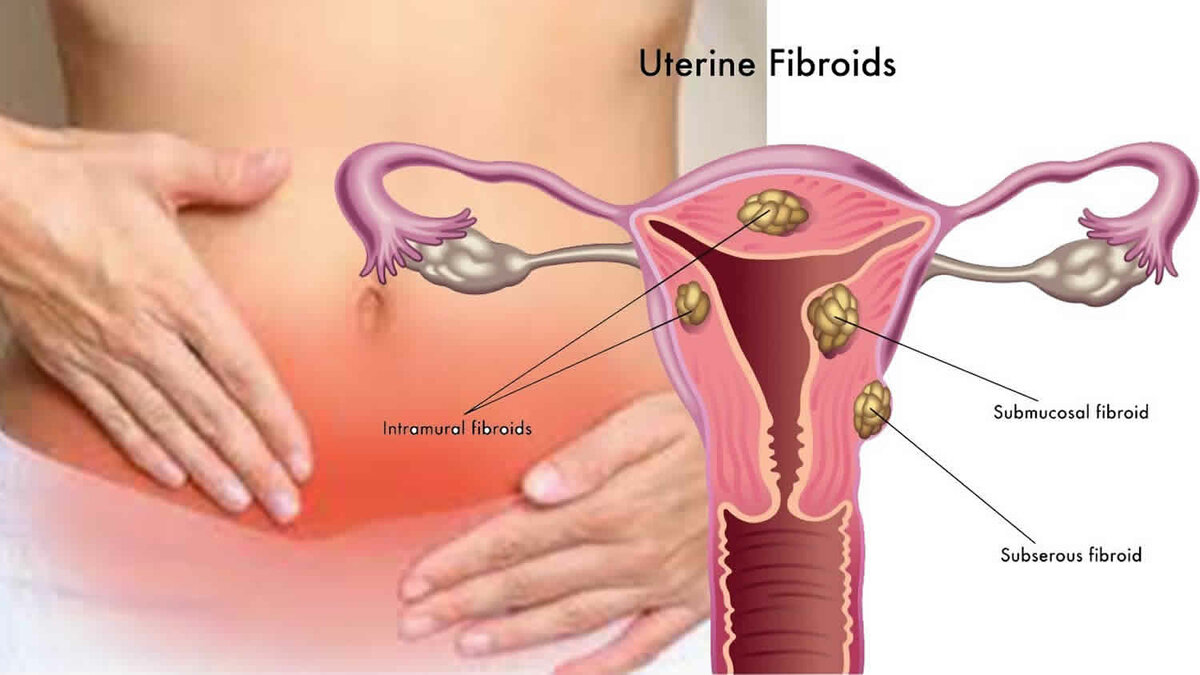 Фиброма матки: 7 тревожных симптомов